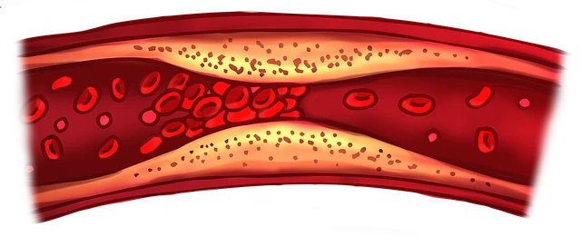 peripheral artery disease