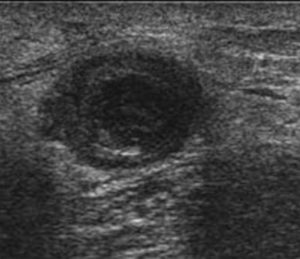 Superficial vein thrombosis