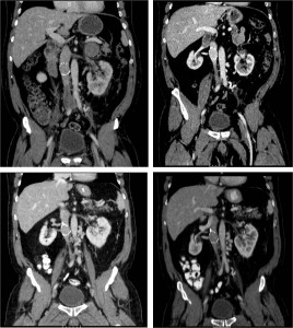 Venous occlusion can result in post phlebitic syndrome