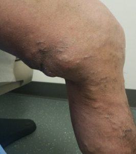One leg swelling from varicose veins