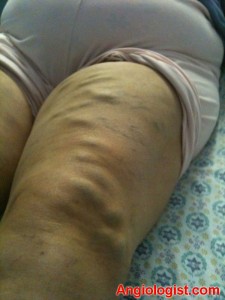Varicose Veins