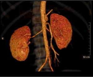 Suspected fibromuscular dysplasia