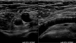 May Thurner iliac vein stent ultrsound