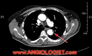 Blue toe source in Aorta