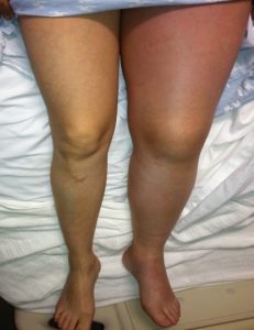 One leg swelling from DVT