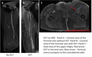 Venous thromboembolism DVT on MRI