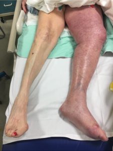 phlegmasia cerulea dolens