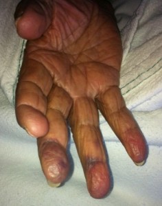 Spontaneous venous hemorrhage