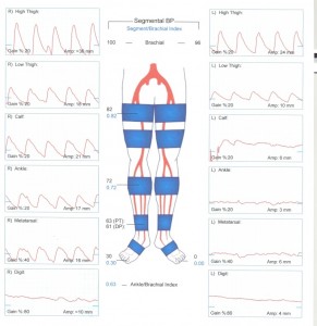 Pulse volume recording (PVR) and segmental pressures