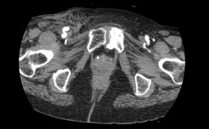 Complications of catheterization - pseudoaneurysm