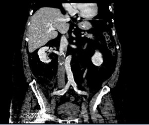 IVC filter with IVC thrombosis
