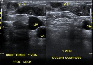 jugular vein thrombosis