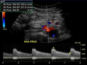 Renal artery stenosis duplex