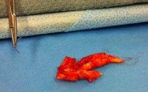 Calcific plaque from endarterectomy