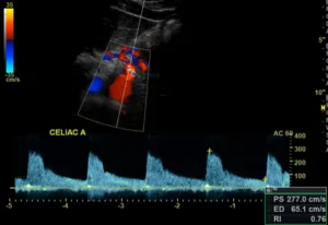 Chronic mesenteric ischemia 