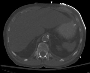 Celiac stent for mesenteric ischemia