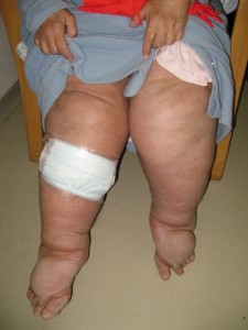 Bilateral lymphedema