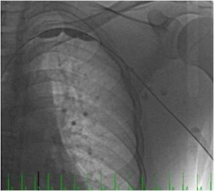 Paget Schroetter Balloon Venoplasty
