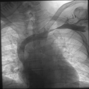 Paget SChroetter Subclavian artery compression