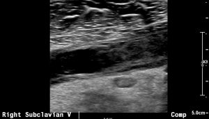 Subclavian vein thrombosis in Paget Schroetter