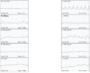 Thoracic outlet syndrome pulse volume recording