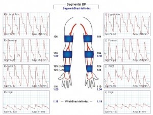 Upper extremity Pulse volume recording