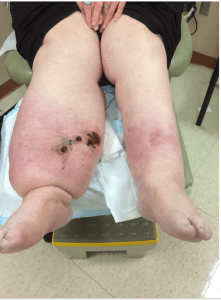 One leg swelling with Stewart Treves