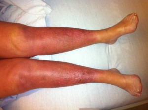 Stasis Dermatitis - A sign of chronic venous insufficiency