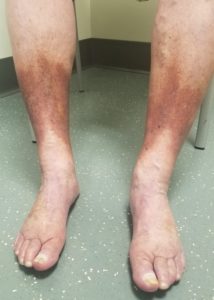 Stasis pigmentation in venous insufficiency