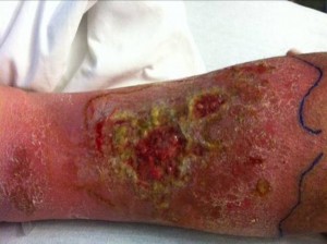 venous ulcer