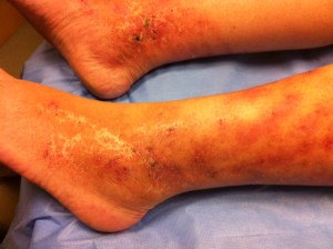 Livedoid vasculopathy