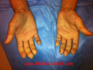 Scleroderma ulcer