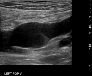 popliteal vein aneurysm