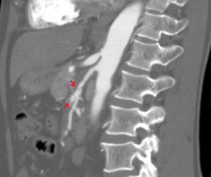 Segmental arterial mediolysis