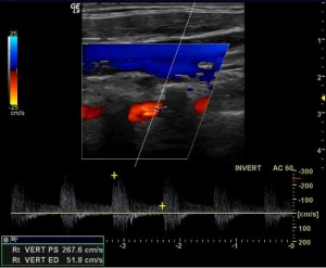 Vertebral artery stenosis ultrasound