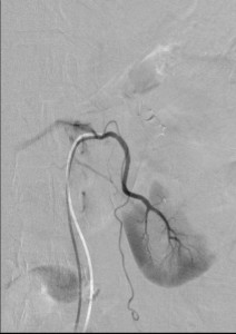 Renal infarction Angiography