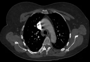 subsegmental pulmonary embolism