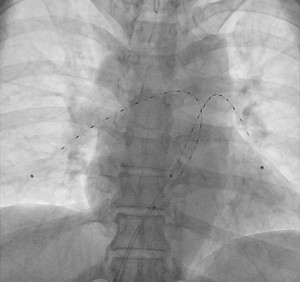EKOS catheters being used for thrombolysis for pulmonary embolism