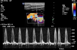 Subclavian artery stenosis duplex