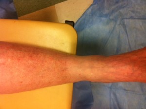 Hyperpigmentation after deep vein thrombosis
