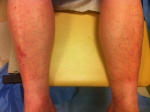 Schamberg Schamberg's capillaritis