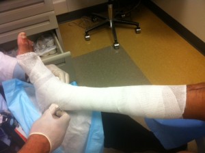 Unna boot application - cover the ulcer