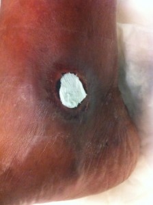 Wet to dry gauze in wound