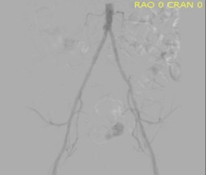Hypoplastic small aorta