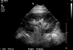 Kidney ultrasound