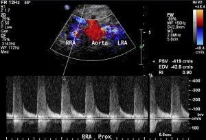 Renal artery ultrasound