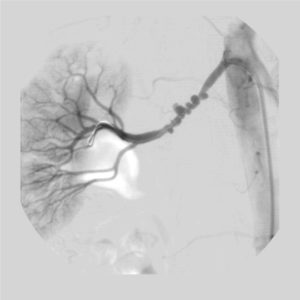 FMD is one of the better described vasculopathies