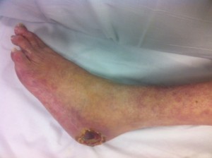 Arterial heel ulcer