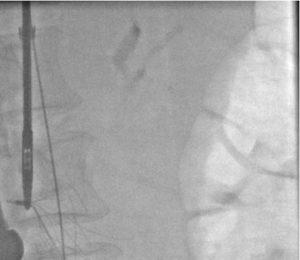Difficult IVC filter retrieval