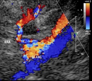 Transplant renal artery ultrasound